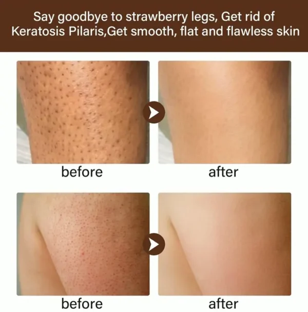 Strawberry Legs Treatment Cream for Women