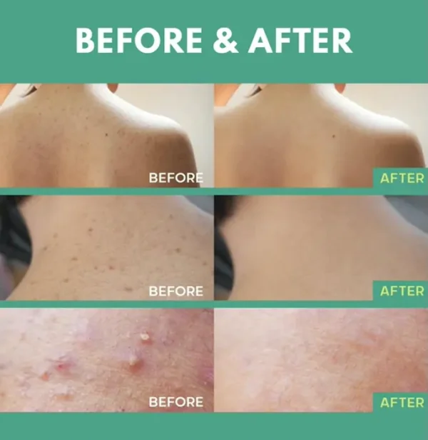 Body Acne Spray: Salicylic Acid, Tea Tree Oil & Niacinamide, 4 oz